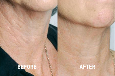 PotentLift Advanced Neck Lifting and Firming Cream Before and After